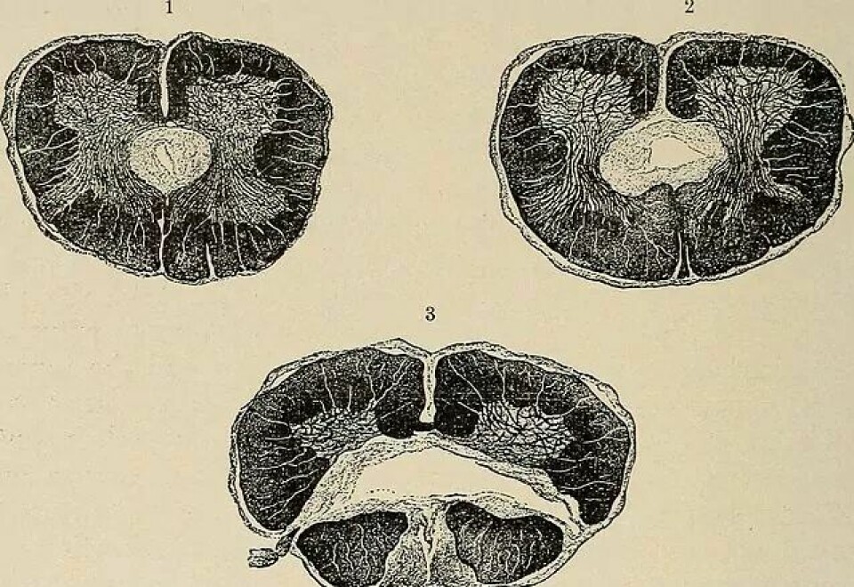 Illustrasjon frå boka Nervous and mental diseases (1911). (Kjelde: Flickr CC0 1.0)