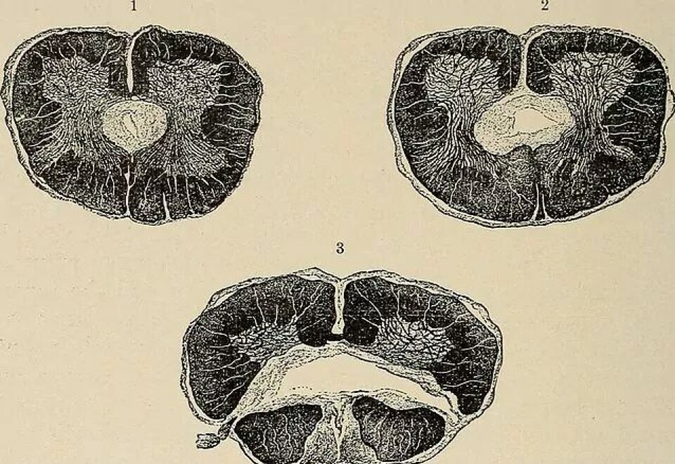 Illustrasjon frå boka Nervous and mental diseases (1911). (Kjelde: Flickr CC0 1.0) Illustrasjon frå boka Nervous and mental diseases (1911). (Kjelde: Flickr CC0 1.0)