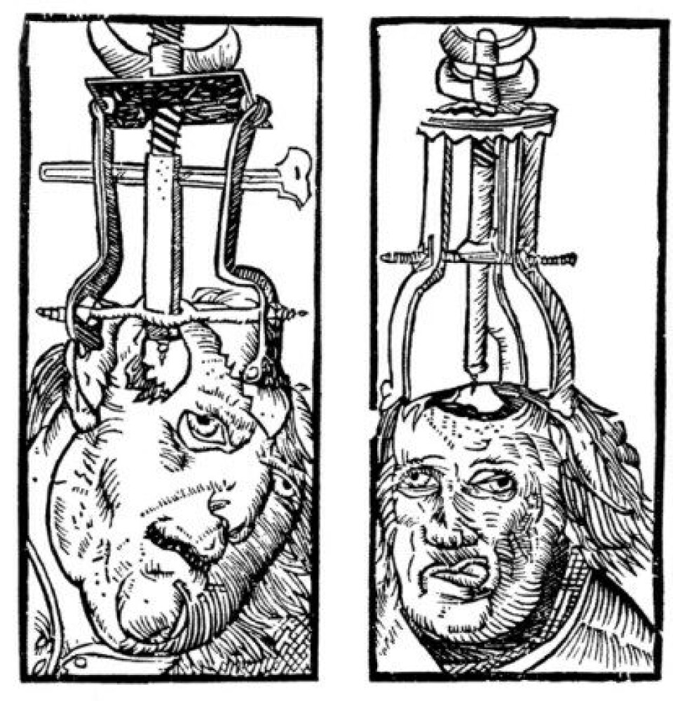 Trepanering presentert i tresnitt fra 1525. (Kilde: Wikimedia commons.) Trepanering presentert i tresnitt fra 1525. (Kilde: Wikimedia commons.)